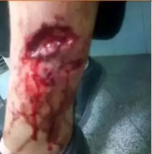 تصاویر ناگوار از حمله سگ های ولگرد به یک دختر دانش آموز  -  عکس