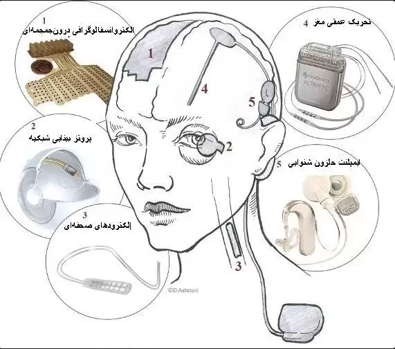 آشنایی با ایمپلنت های مغزی یا وسایل کاشتنی مغزی