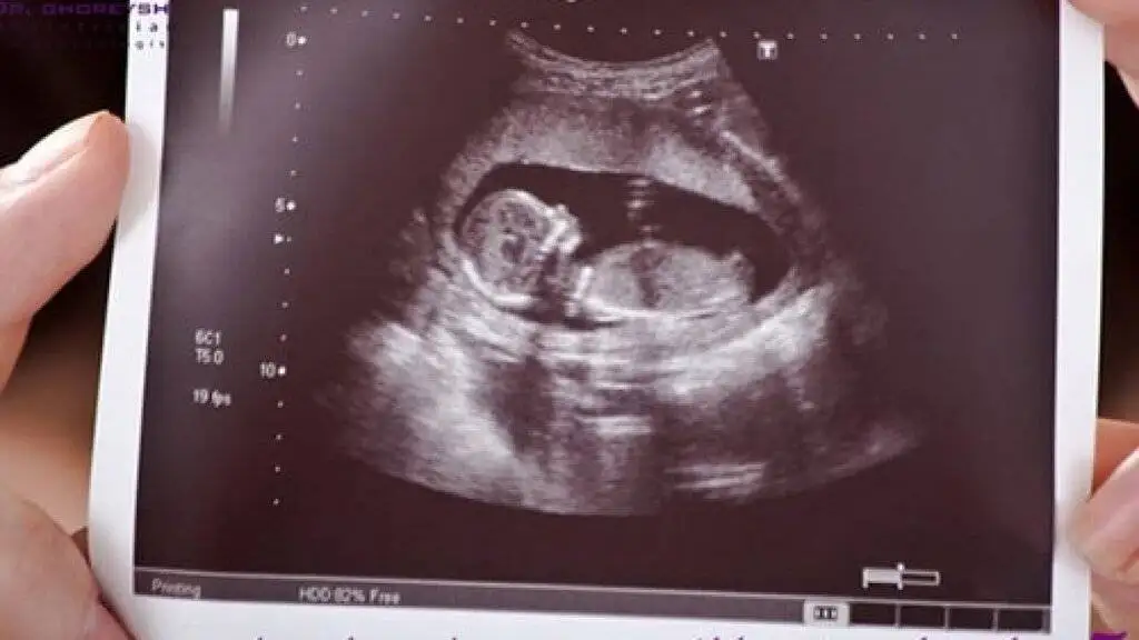 پیشگیری روی کاغذ، معلولیت در واقعیت -  بهزیستی با غربالگری های (30 ساله)، قادر به پیشگیری از بروز معلولیت نیست