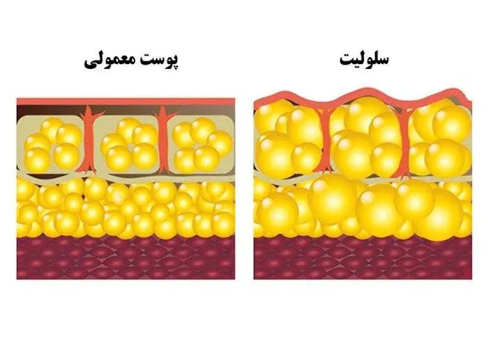 5 راه ساده برای درمان سلولیت در خانه