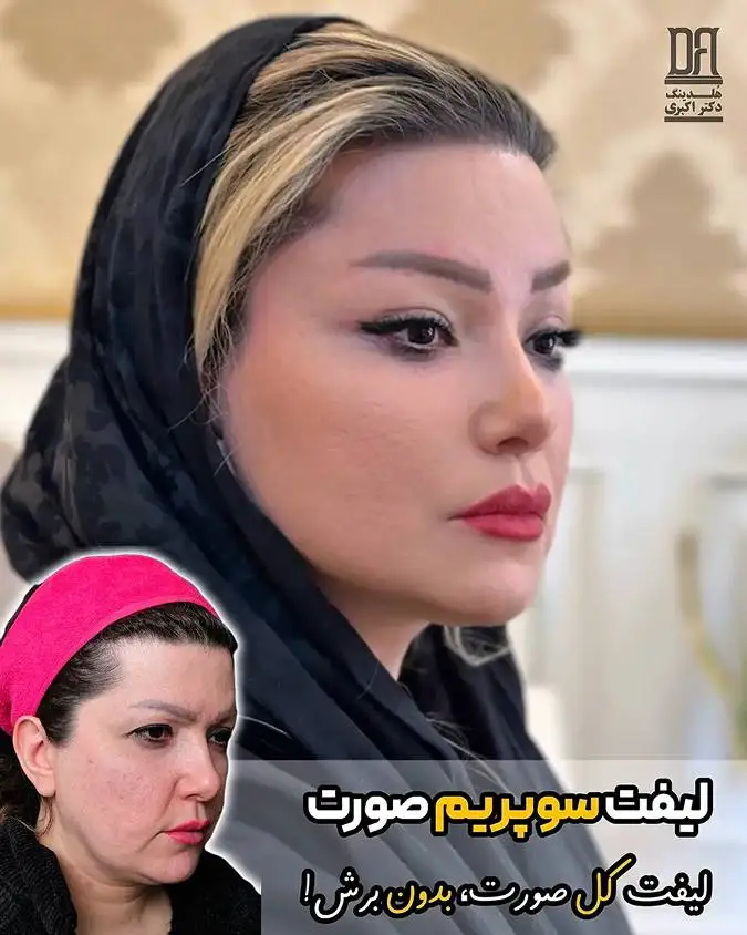 توسعه یک تکنیک نوین لیفت صورت در ایران پس از 15 سال تحقیق و بررسی تخصصی