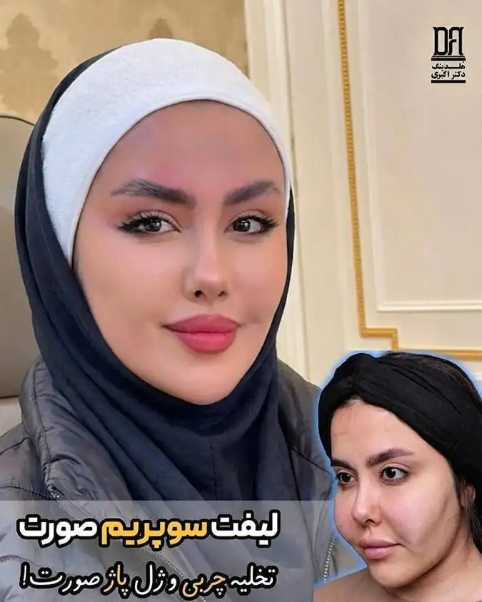 توسعه یک تکنیک نوین لیفت صورت در ایران پس از 15 سال تحقیق و بررسی تخصصی