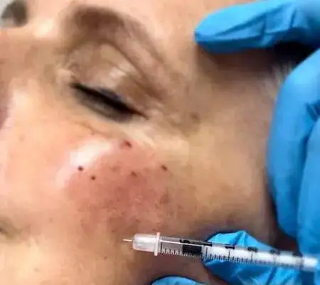 بوتاکس های تقلبی بیشتر کجا توزیع می شوند و چه عوارض مهمی دارند؟  -  هشدار یک متخصص: مشکل فقط حوزه زیبایی نیست، بیماران هم در معرض خطرند