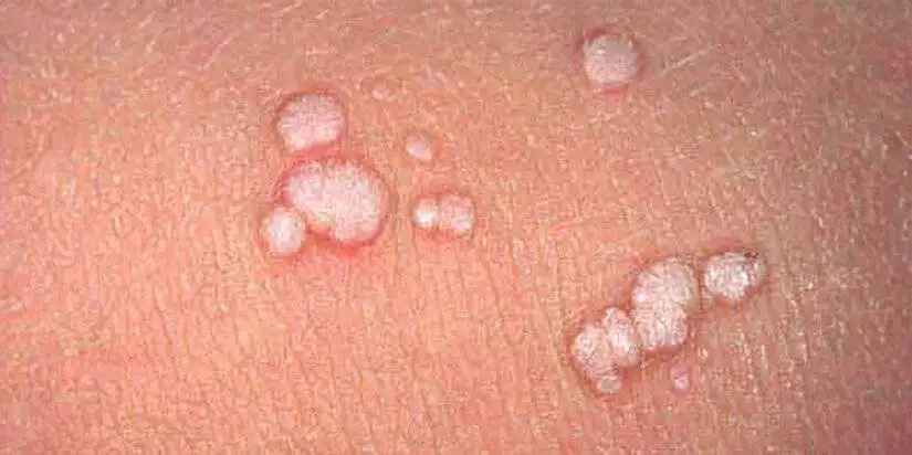 ویروس زگیل از باشگاه ورزشی منتقل می شود؟