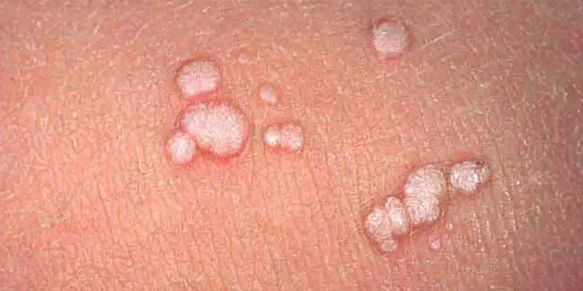 زگیل از باشگاه ورزشی منتقل می شود؟؛ اشتباهی که خطر ابتلا را بیشتر می کند