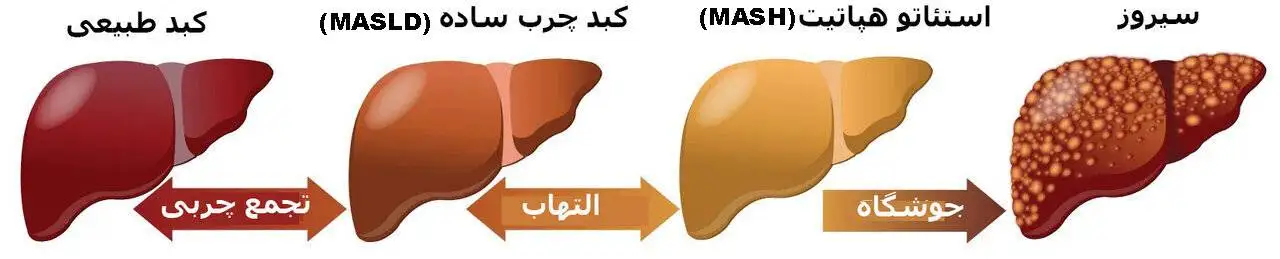 کبد چرب، کبد را پیش از 50 سالگی از پا درمی آورد