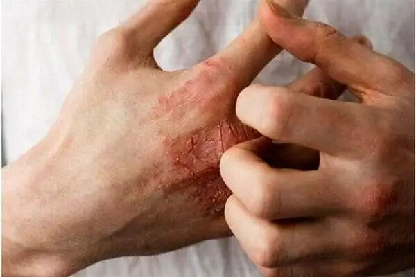 طاعون چطور منتقل می شود و چه علائمی دارد؟