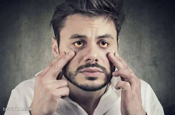 واقعا کمبود آهن را می توان از روی چهره تشخیص داد؟ علائمی که باید جدی بگیرید