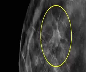 ماموگرافی برای غربالگری سرطان از 40 سالگی