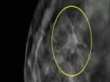 ماموگرافی برای غربالگری سرطان از 40 سالگی