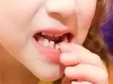 دندان شیری کی می افتد؟