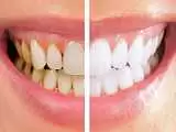 10 روش  موثر برای سفید کردن دندان با مواد طبیعی