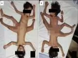 تصاویر شوکه کننده از 2 قلوهای عنکبوتی  -  3 پا و 4 دست دارند!