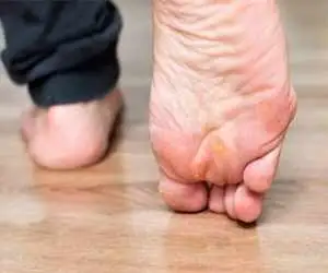 میخچه پا چیست و چگونه درمان می شود؟ + عکس میخچه پا