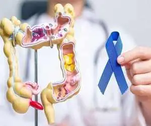 یافته های جدید درمورد پیشگیری از سرطان روده