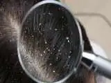 اگر شما هم شوره سر دارید بهتر است آن را جدی بگیرید