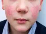 بیماری هزار چهره سیستم ایمنی که ناگهان شعله ور می شود + ویدئو