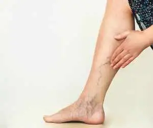برای پیشگیری از واریس این عادت روزانه را جدی بگیرید