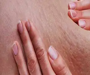 5 راه ساده برای درمان سلولیت در خانه
