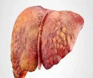 این هشت نشانه یعنی شما به کبد چرب مبتلا هستید