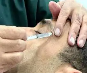 بوتاکس های تقلبی بیشتر کجا توزیع می شوند و چه عوارض مهمی دارند؟  -  هشدار یک متخصص: مشکل فقط حوزه زیبایی نیست، بیماران هم در معرض خطرند