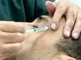 بوتاکس های تقلبی بیشتر کجا توزیع می شوند و چه عوارض مهمی دارند؟  -  هشدار یک متخصص: مشکل فقط حوزه زیبایی نیست، بیماران هم در معرض خطرند