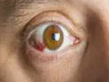 لکه خونی در چشم چقدر خطرناک است؟ چه زمانی باید به پزشک مراجعه کرد؟