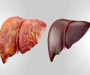متداول ترین بیماری کبدی جهان چیست؟