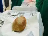 باورنکردنی؛ سنگ 3 کیلویی از مثانه یک مرد 55 ساله خارج شد! -  عکس