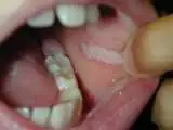 چرا زخم دهان می زنیم؟؛ 6 دلیل شایع و یک هشدار مهم