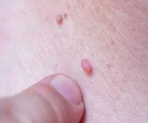 ویروس زگیل از باشگاه ورزشی منتقل می شود؟