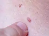 ویروس زگیل از باشگاه ورزشی منتقل می شود؟