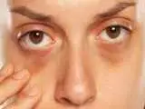 تیرگی دور چشم ارثی است یا نشانه بیماری؟  -  آیا کرم ها می توانند تیرگی زیر چشم را برطرف کنند؟