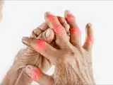 12 خوراکی که التهاب بدن را بیشتر می کند؛ چه رژیمی برای مفاصل مناسب تر است؟