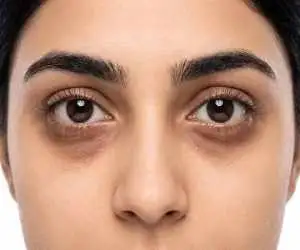 دلیل تیرگی و پف زیر چشم چیست؟ راه حل های مراقبت از پوست دور چشم