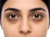 دلیل تیرگی و پف زیر چشم چیست؟ راه حل های مراقبت از پوست دور چشم