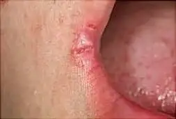 این عادت ساده باعث ترک گوشه لب می شود
